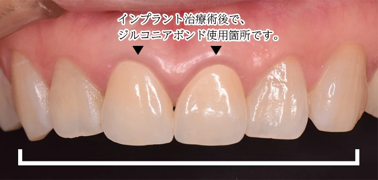 前歯の写真